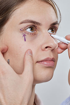 Blepharoplasty